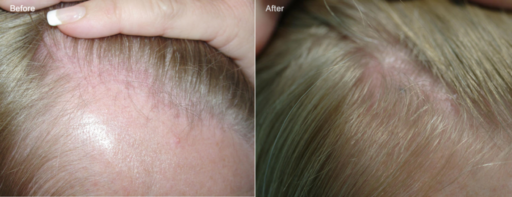 przed i po kobieta blond lysienie