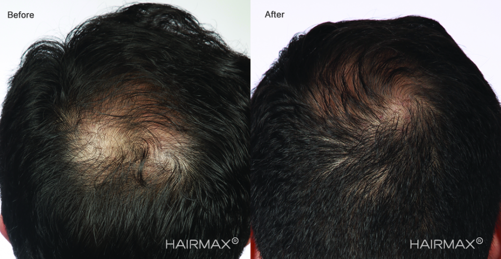 przed i po efekt grzebien laserowy LLLT