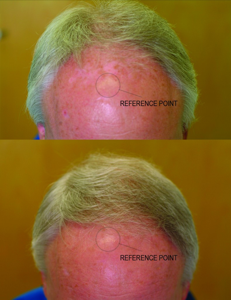 przed i po lysienie mezczyzna grzebien laserowy