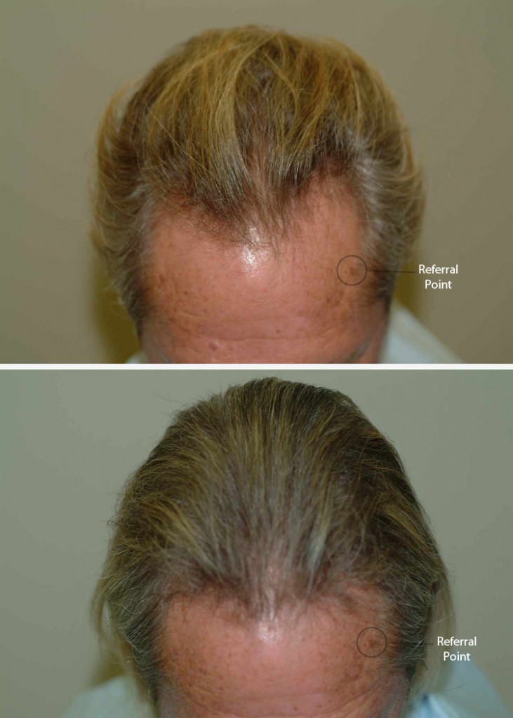 przed i po grzebien laserowy mezczyzna lysienie