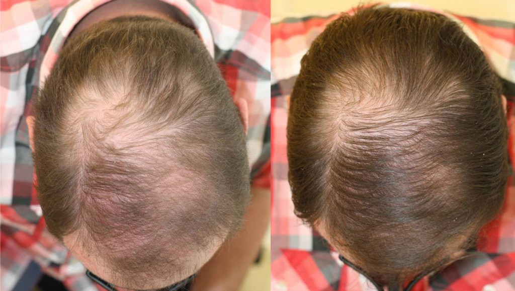 przed i po kuracja grzebien laserowy mezczyzna 5