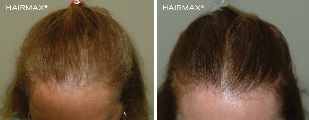 przed i po kobieta grzebien laserowy