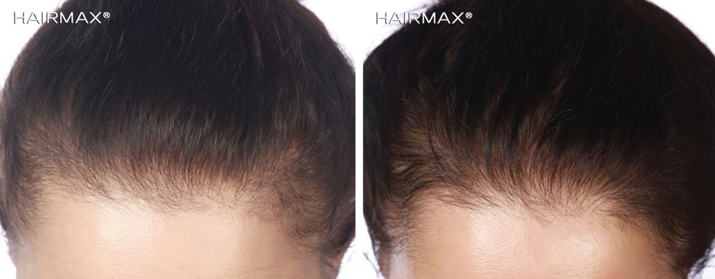 przed i po lysienie kobieta efekt grzebien laserowy