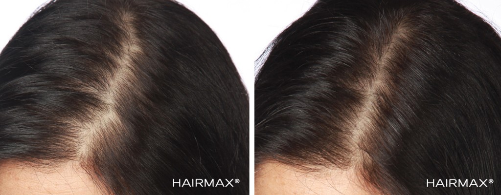 przed i po kobieta hairmax