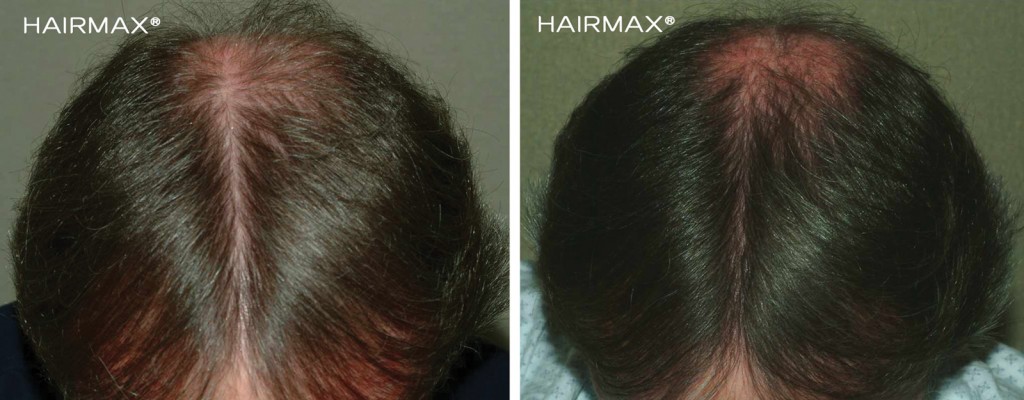 przed i po efekt po odbytej kuracja grzebien laserowy LLLT hairmax mezczyzna 10