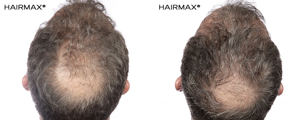 przed i po kuracja grzebien laserowy LLLT mezczyzna 2