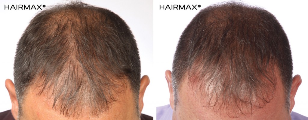 przed i po kuracja grzebien laserowy hairmax mezczyzna 7