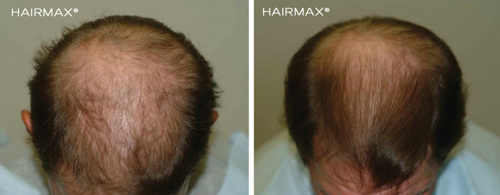 przed i po kuracja laser LLLT hairmax mezczyzna 9