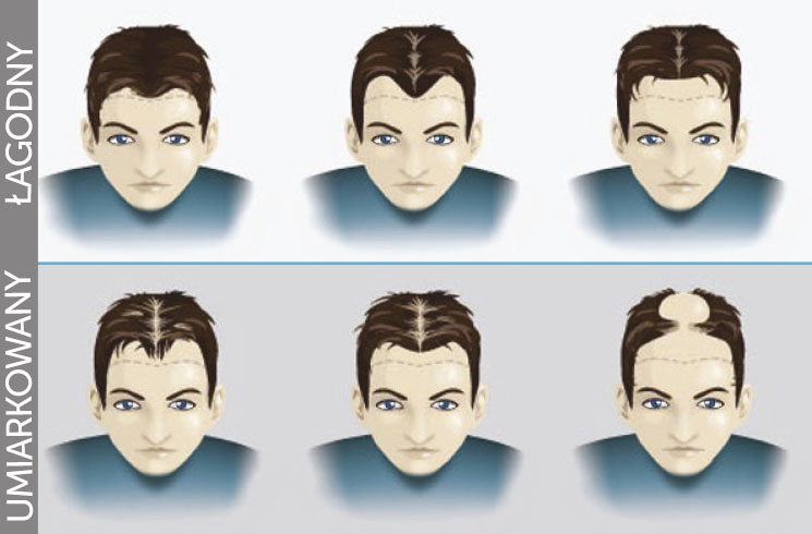 etapy lysienia mezczyzna