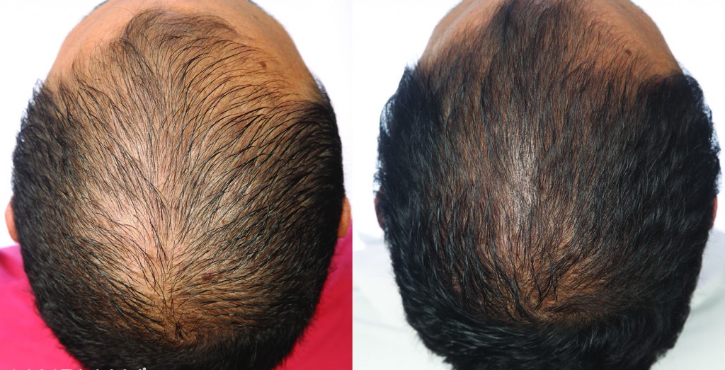 przed i po kuracja grzebien laserowy LLLT hairmax mezczyzna jean