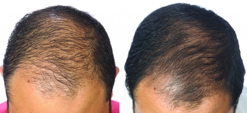 przed i po kuracja grzebien laserowy LLLT mezczyzna jean