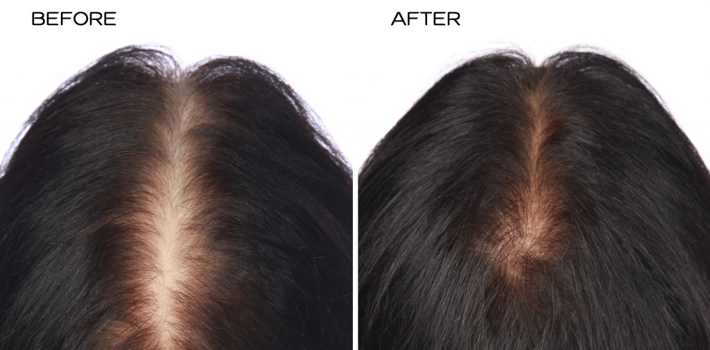 przed i po kuracja grzebien laserowy hairmax mezczyzna leoni